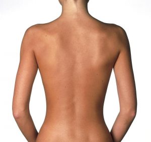 back-liposuction-houston